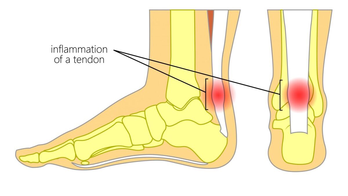 Achilles-Tendonitis-scaled-1200x675-cropped