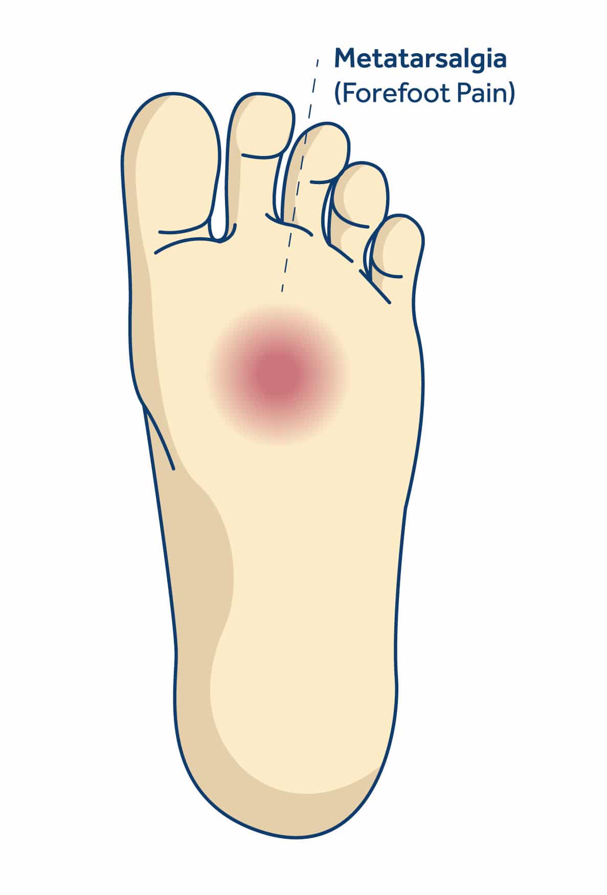 metatarsalgia-forefoot-pain
