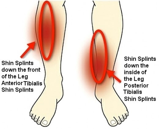 shin-splints-image-2