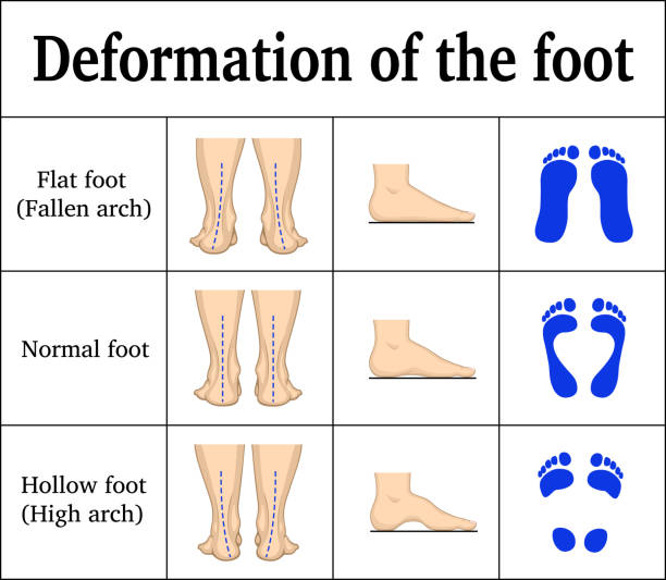 Illustration of the deformation of the foot - flat feet and a hollow foot. There are footprints, the form of the foot on the side and behind